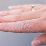 علائم پوستی کمبود ویتامین B12