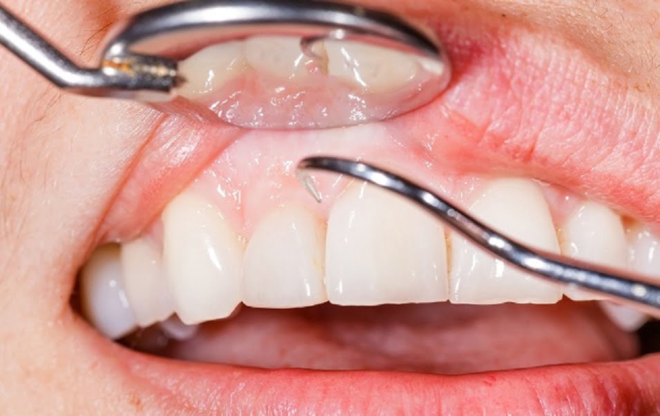 درمان های غیر جراحی پریودنتال