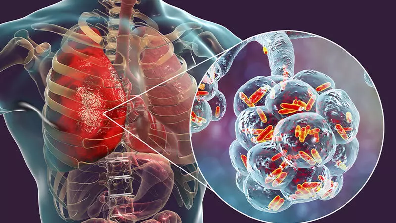 اقدامات مداخله ای بیماریهای تنفسی