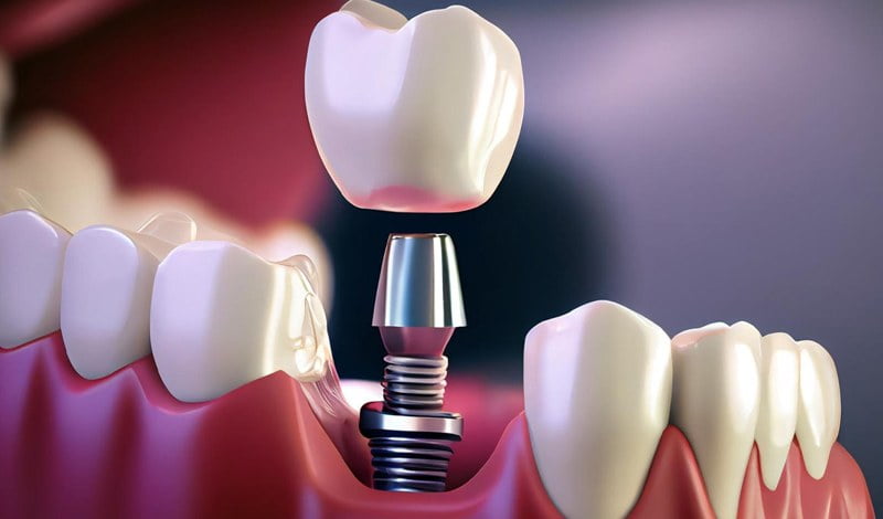 ایمپلنت در دندانپزشکی