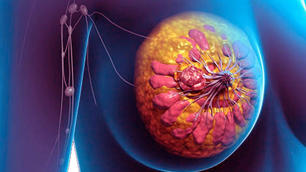 آسیب شناسی پستان