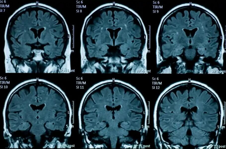 تصویربرداری پرفیوژن با MRI