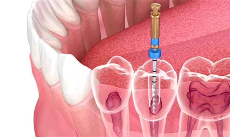 درمان مجدد ریشه